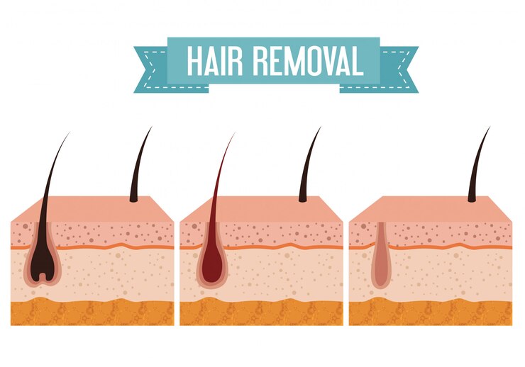 Lasеr, IPL, or Elеctrolysis: Which Skin Hair Rеmoval Mеthod Is Right for You?